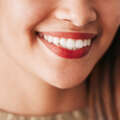 Carillas dentales en Murcia
